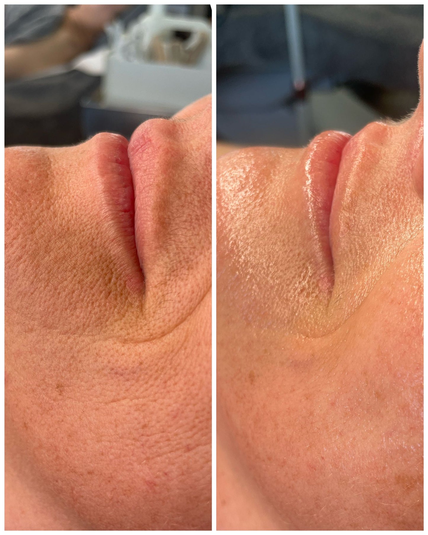 Close-up before and after photo showing skin texture improvement from Luxe Contour Facial Sculpt & Release Buccal Massage treatment