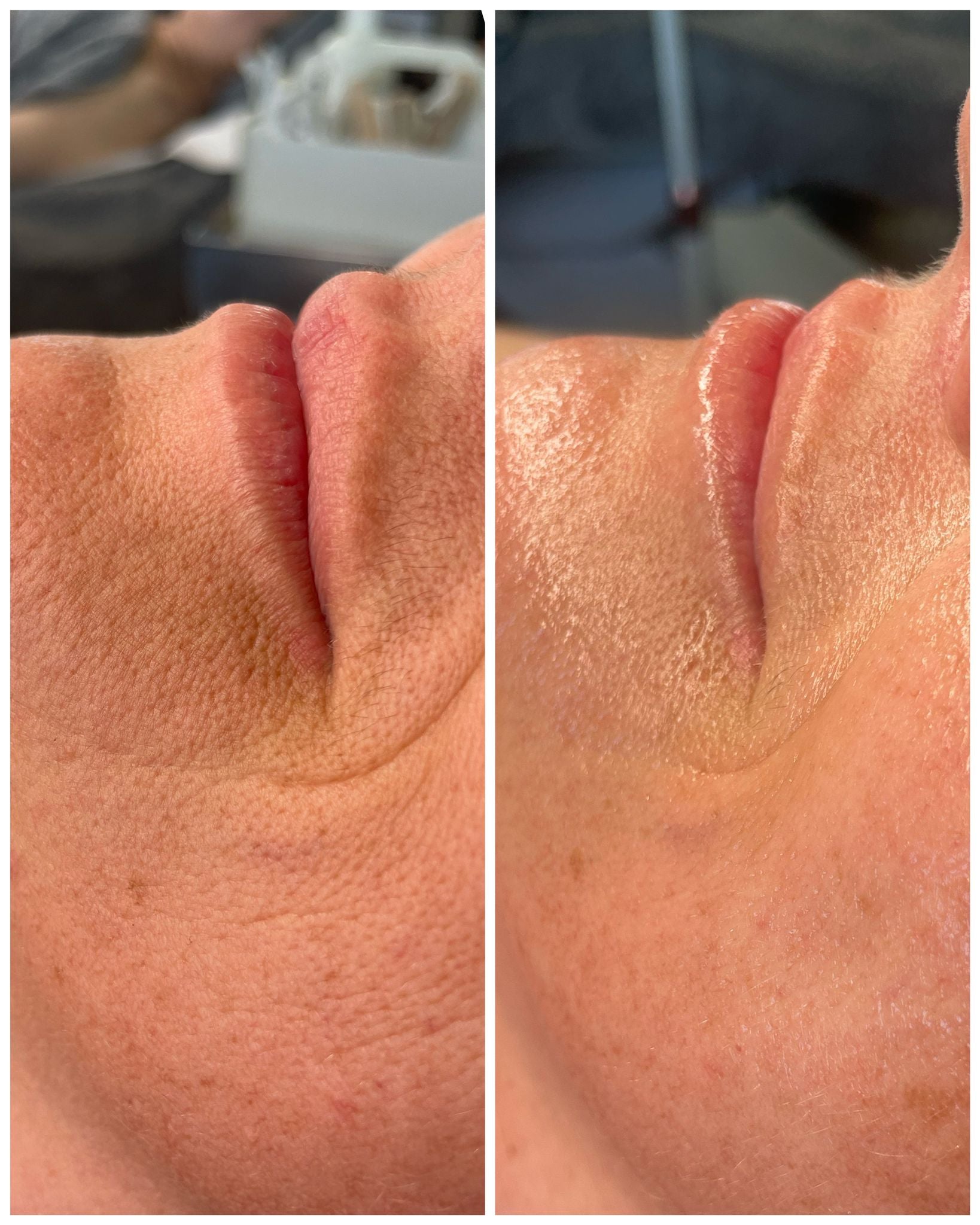 Close-up before and after photo showing skin texture improvement from Luxe Contour Facial Sculpt & Release Buccal Massage treatment