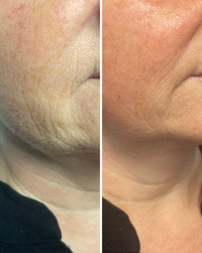 Close-up before and after results of Luxe Contour Facial Sculpt & Release Buccal Massage showing reduced wrinkles and smoother skin.