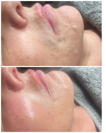 Close-up before and after images showing visible skin improvement from Luxe Contour Facial Sculpt & Release Buccal Massage treatment
