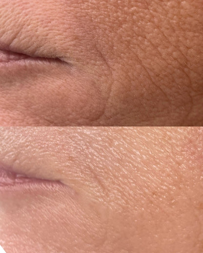 Close-up before and after images showing improved skin texture and reduced wrinkles from buccal facial massage treatment