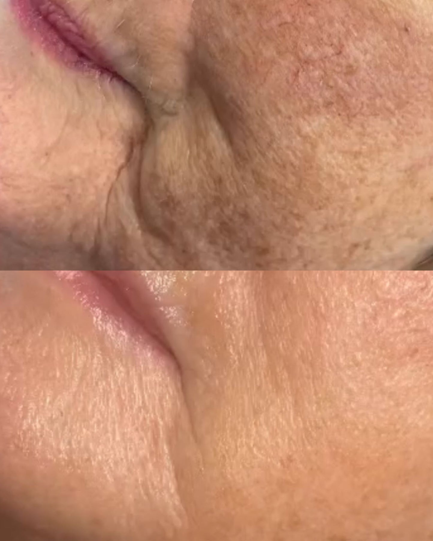 Close-up before and after images showing reduced wrinkles and improved skin texture after facial contour buccal massage.