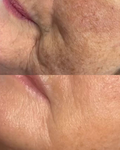 Close-up before and after images showing reduced wrinkles and improved skin texture after facial contour buccal massage.