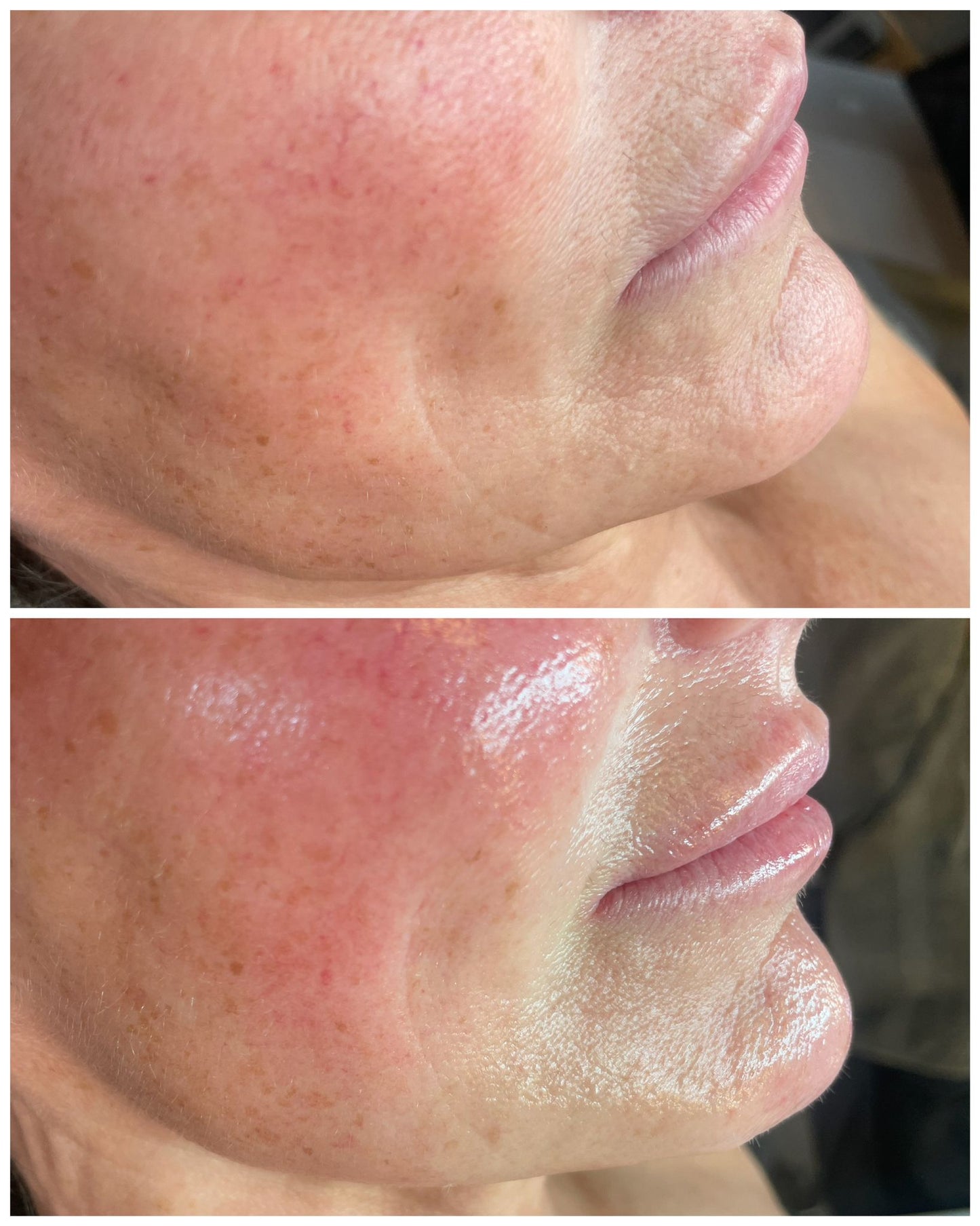 Before and after close-up of cheek contouring showing improved skin texture and glow from buccal facial massage treatment