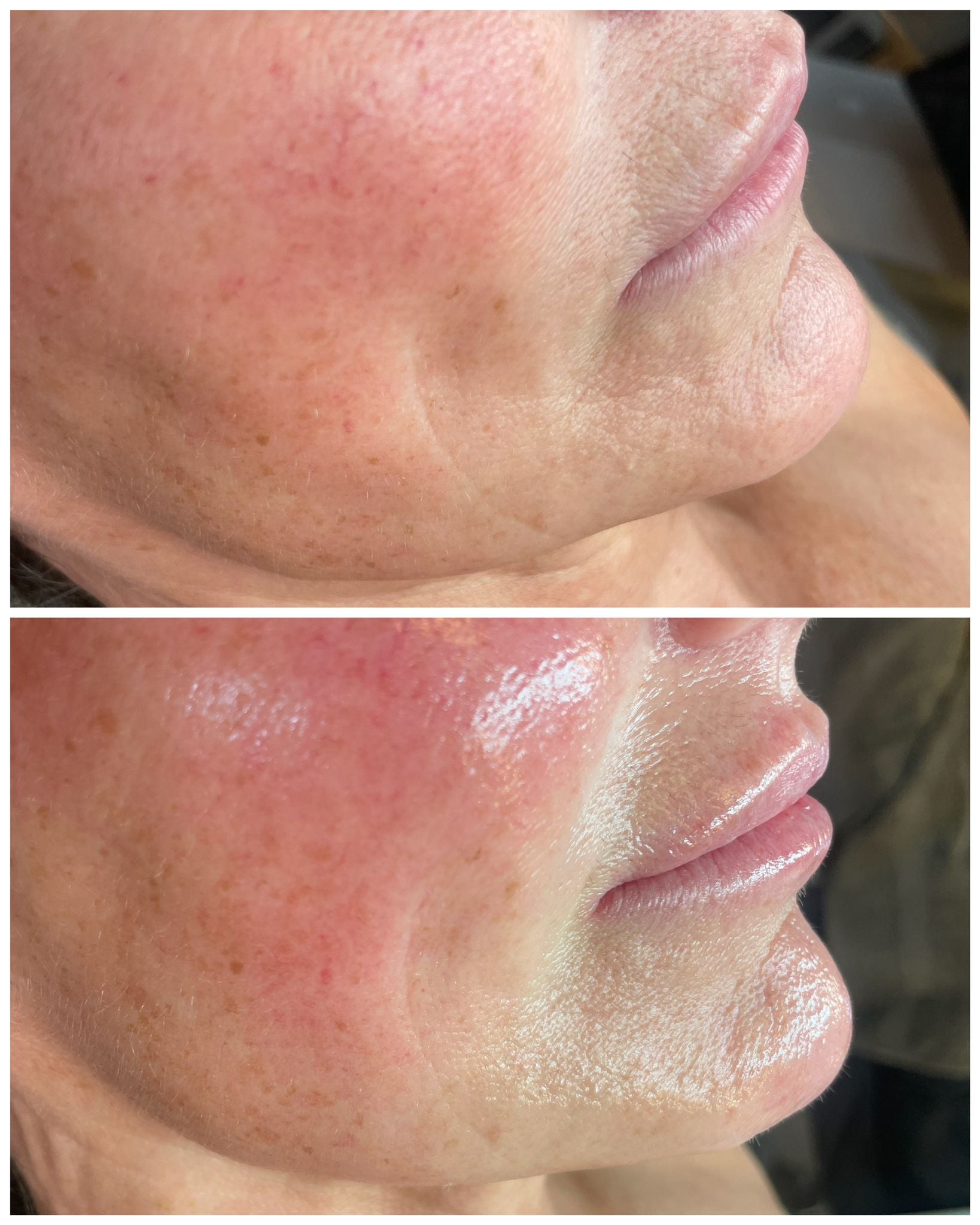 Before and after close-up of cheek contouring showing improved skin texture and glow from buccal facial massage treatment