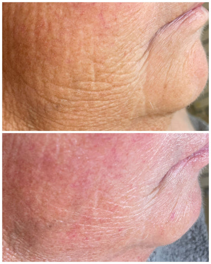 Close-up before and after images showing reduced wrinkles and improved skin texture from buccal facial massage treatment