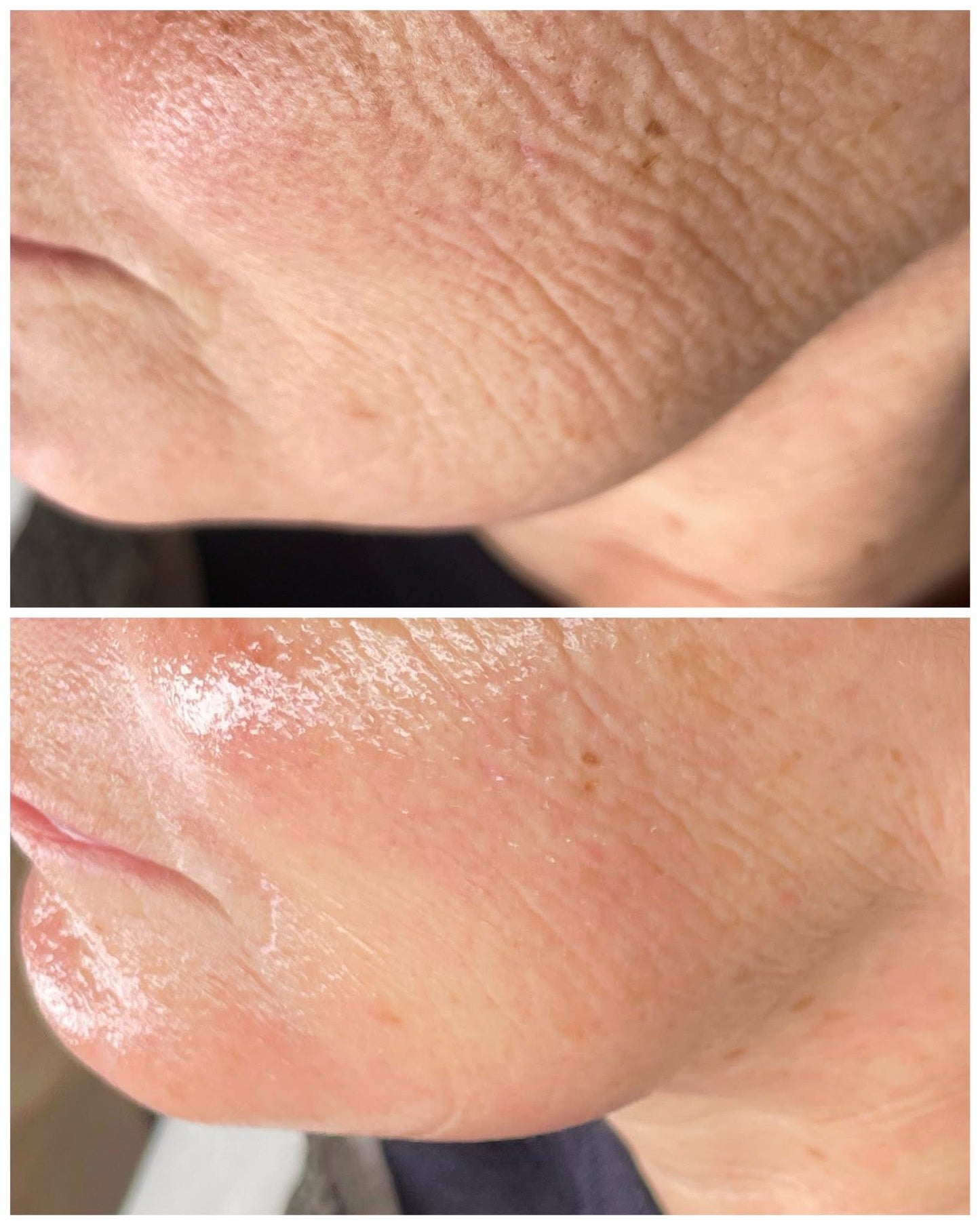 Before and after close-up of facial skin showing reduced wrinkles and improved texture after buccal massage treatment