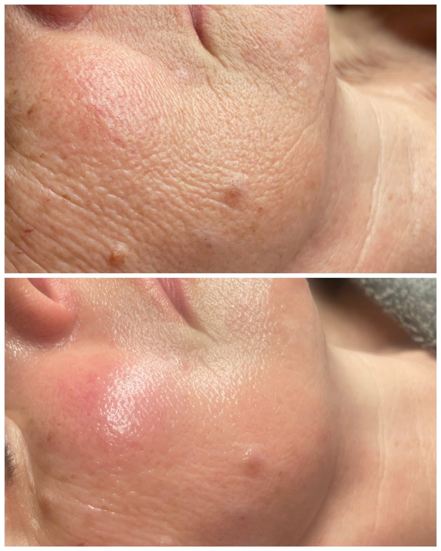 Close-up before and after images showing improved skin texture and reduced wrinkles on cheek after facial massage treatment