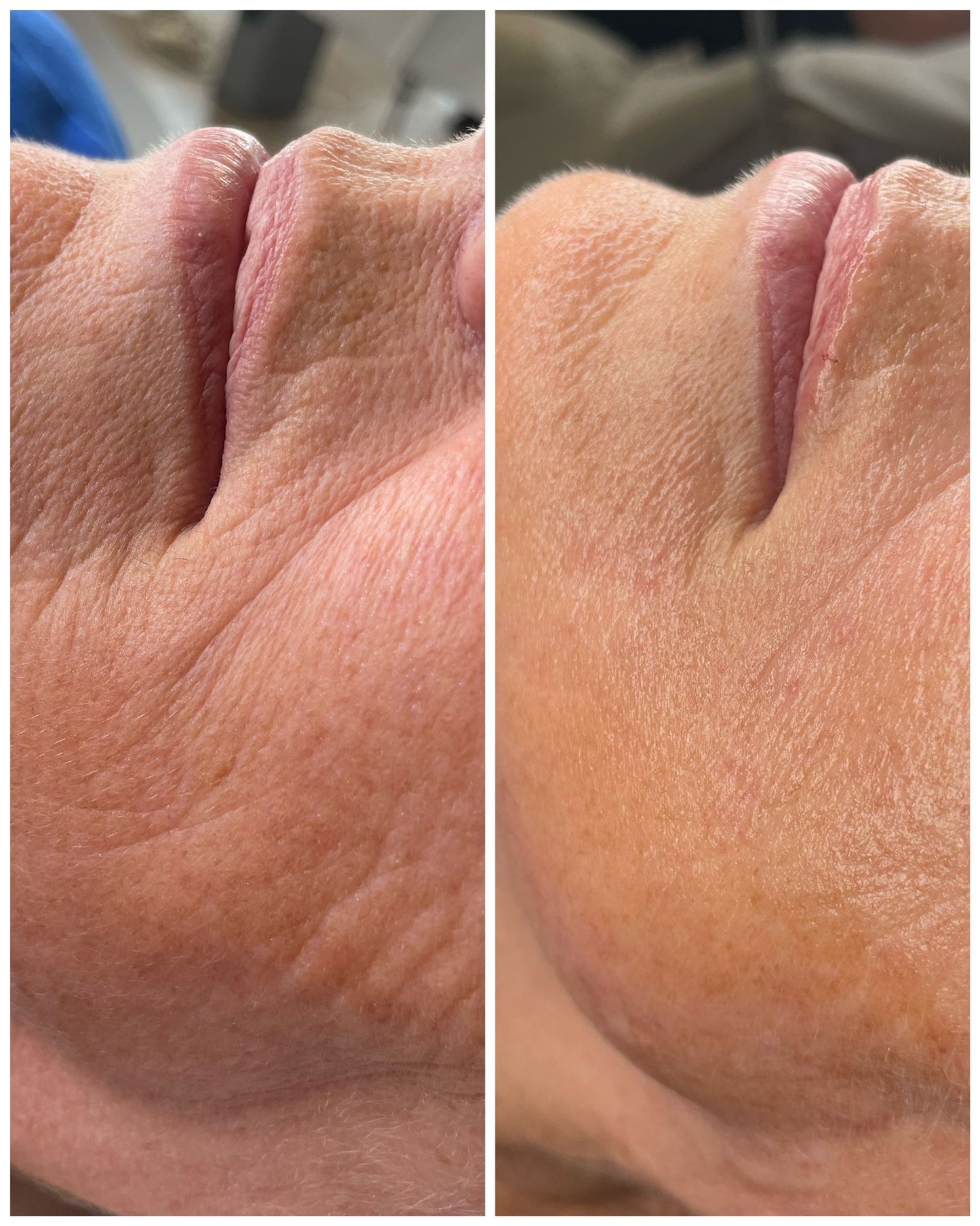 Close-up before and after image showing reduced wrinkles and smoother skin after luxury facial contour and buccal massage treatment